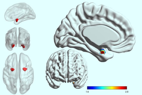 V poslední době se velmi často diskutuje o roli části mozku zvané amygdala, jako o klíči k diagnóze bipolární poruchy i jiných vážných psychických poruch